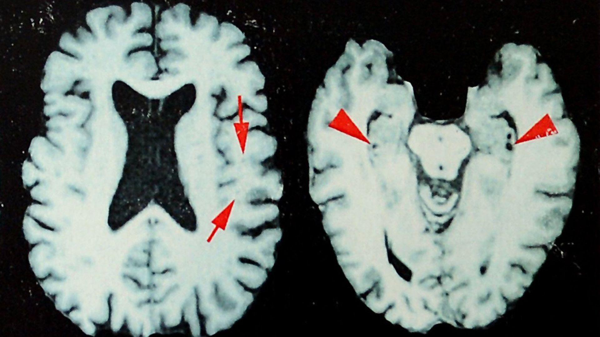 Study Reveals Nearly All Deceased NFL Players Suffered Brain Disease