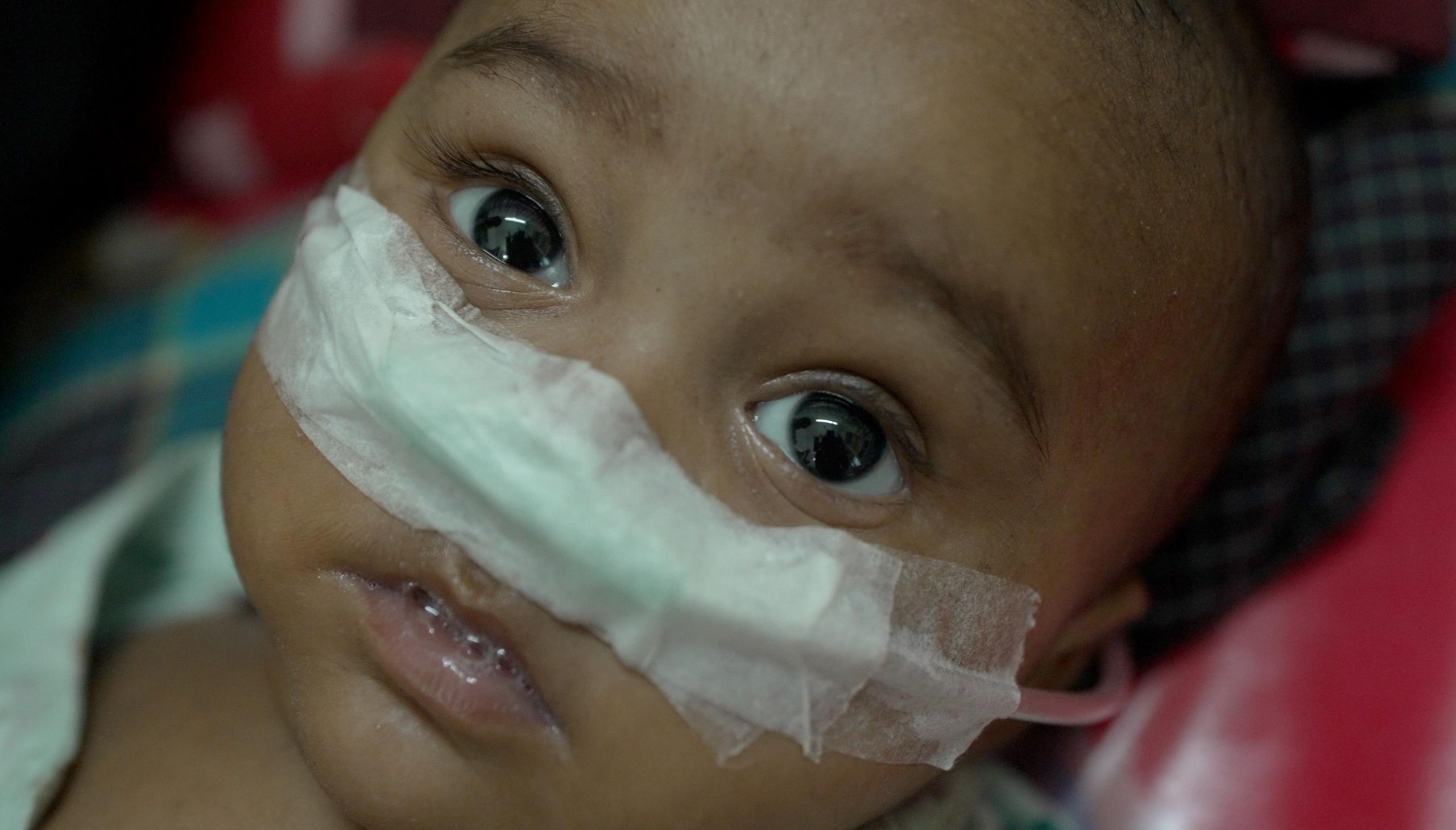 Bangladesh Faces Measles Crisis: 750 Deaths in Four Months